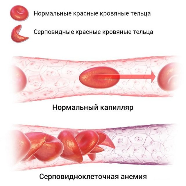 Показатели RDW в анализе крови иследование расшифровка диагноз