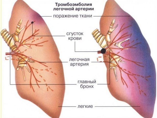 Тромбоз артерий нижних конечностей симптомы лечение