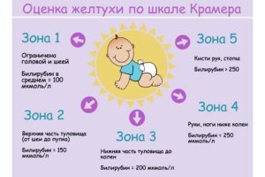 Билирубин у новорожденных