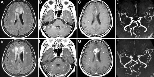 Симтомы, диагностика и лечение закупорки кровеносных сосудов