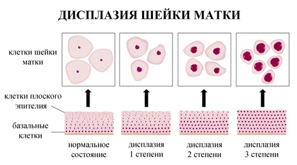 Онкоцитология шейки матки - мазок на онкоцитологию. Цитограмма воспаления с расшифровкой
