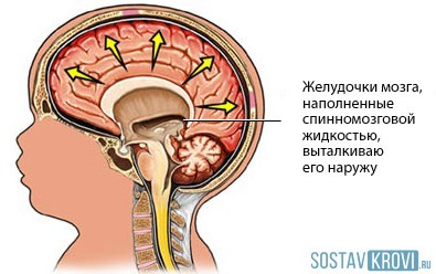Гипертензионный синдром у детей и взрослых: симптомы, лечение