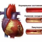 Тромб в сонной артерии: лечение, симптомы и удаление