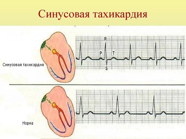 Берут ли в армию с тахикардией в 2019 году?