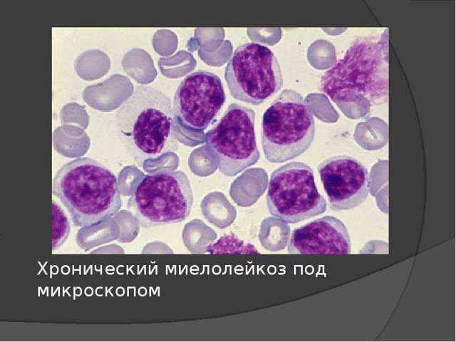 Лейкоз - злокачественное заболевание крови