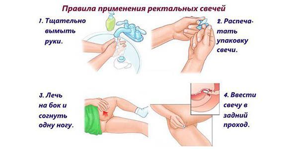 Свечи Проктозан от геморроя и правила их применения