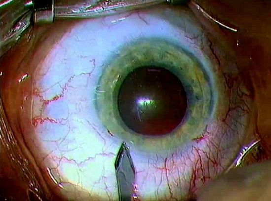 Глазные капли Диклофенак: инструкция по применению Дикло Ф, аналоги, показания, отзывы