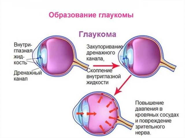 Почему лопаются сосуды в глазах? Причины и лечение