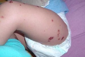 Васкулит детский