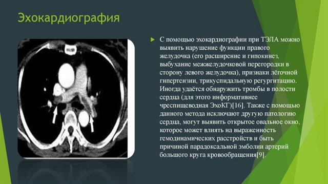 Что показывает ЭХО сердца: расшифровка результатов и нормальные показатели
