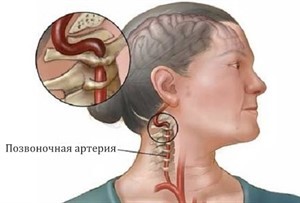 Асимметрия v4 сегментов позвоночных артерий d s. Можно ли вылечить синдром позвоночной артерии при остеохондрозе
