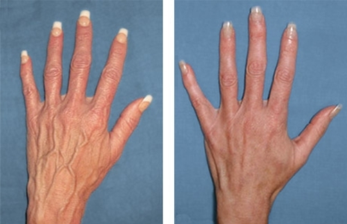 Почему видны вены на руках и как их убрать?