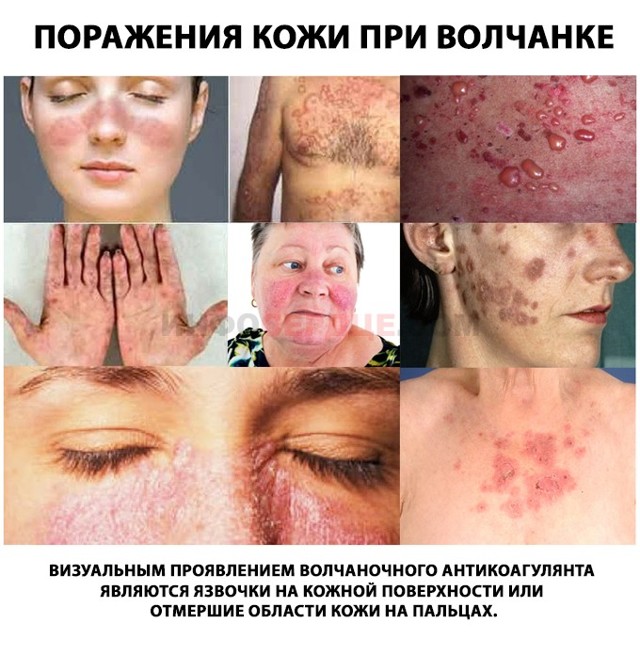 Волчаночный антикоагулянт в анализе беременной, подготовка к анализу