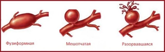 Виды аневризм сосудов головного мозга: классификация по размеру, форме, локализации (ПСА, ПМА, базилярной артерии и других)