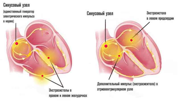 Аритмия какая бывает