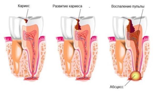 Абсцесс зуба– причины, симптомы и лечение
