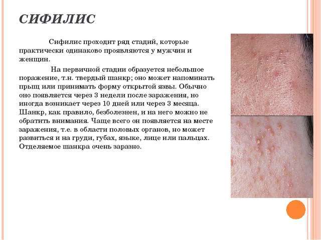 Сифилис у женщин – первые признаки, симптомы, лечение