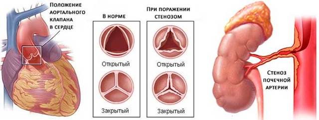 Ингибиторы АПФ: список препаратов при гипертонии. Ингибиторы АПФ – что это такое?