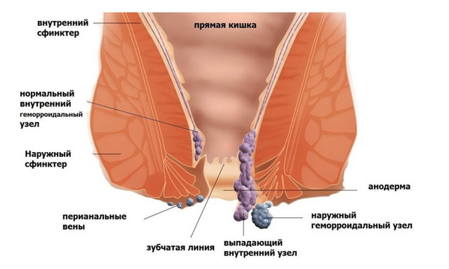 Узлы в прямой кишке - Геморроидальные узлы
