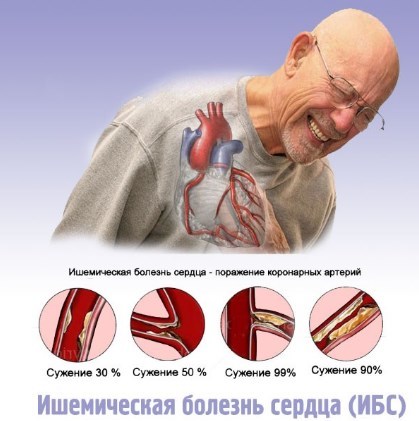 Физические упражнения при стенокардии сердца