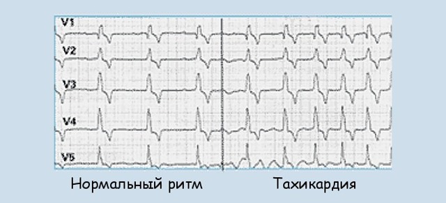 Тахикардия сердца: симптомы, диагностика и лечение - DELFI