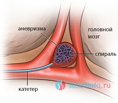 Клипирование аневризмы артерий головного мозга