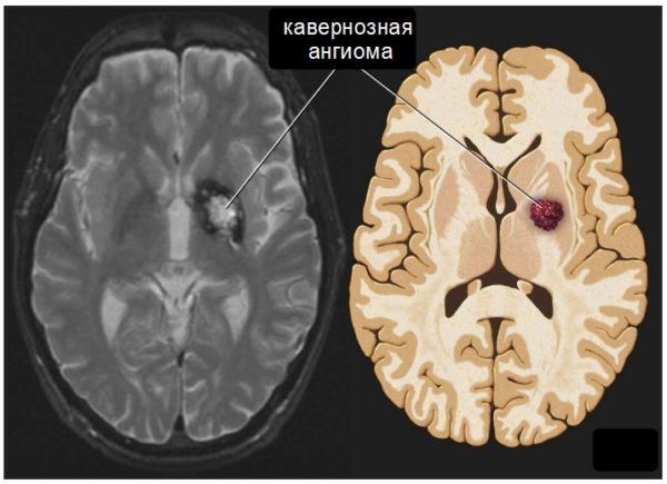 Ангиома головного мозга - Здоровая кожа