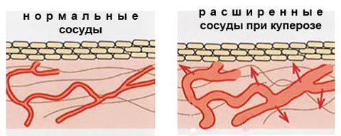 Капиллярная сетка – что это такое? Сосудистые звездочки на руках (купероз)
