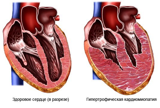 Тренировки и упражнения для сердца
