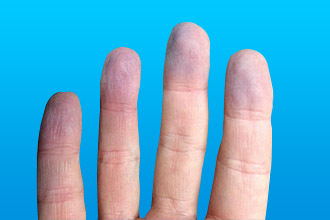 Аортальный порок сердца: симптомы и лечение