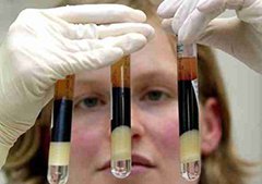 Анализ крови на HCV и HBS: что это означает?