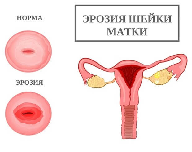 Ихтиоловые свечи - инструкция по применению