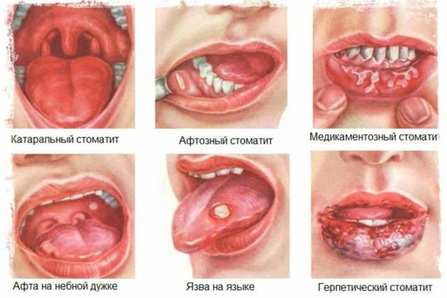 Афтозный стоматит у детей и взрослых: фото, лечение
