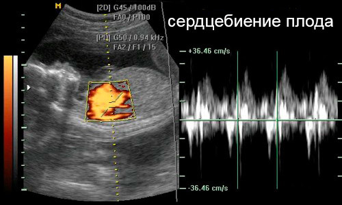 На каком сроке слышно сердцебиение плода на УЗИ?