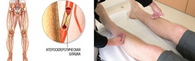 Как проверить холестериновые бляшки в сосудах, диагностировать атеросклеротические бляшки