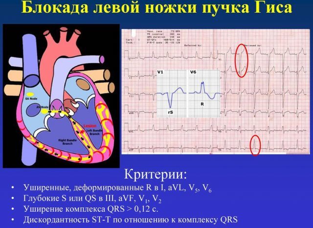 Чем опасна блокада ножек пучка гиса и как ее лечить