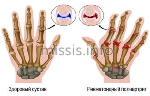Анализ крови фибриноген норма у женщин