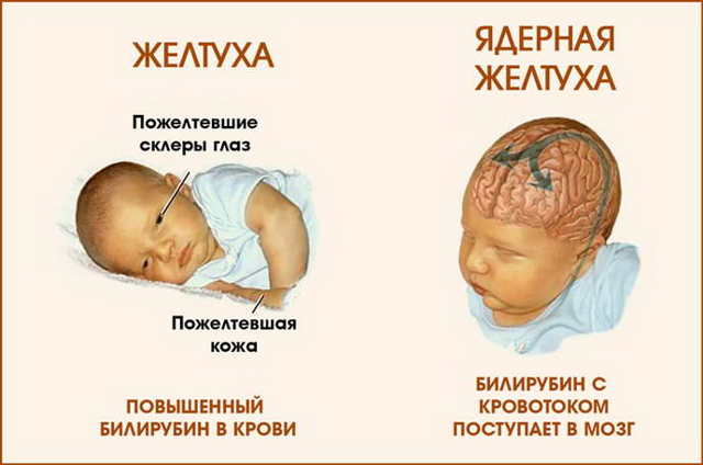 Билирубин у новорожденных