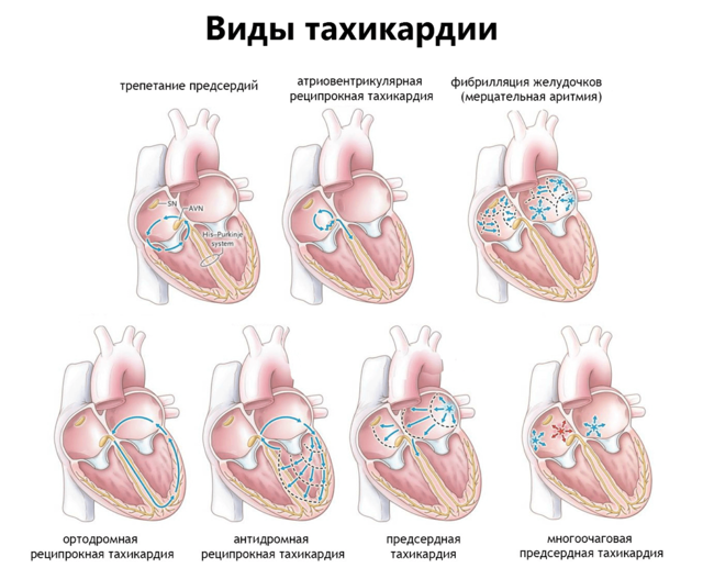 Какие лекарства пить при тахикардии