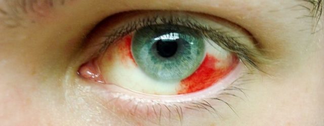 Почему лопнул капилляр в глазу, что делать?