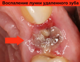 Болит десна после удаления зуба – как быть и что делать