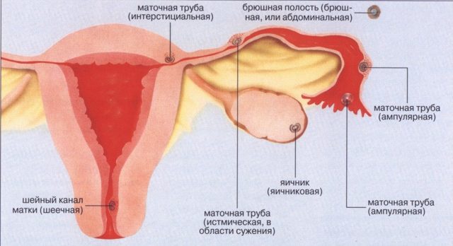 Маточное кровотечение - причины, признаки, симптомы и лечение