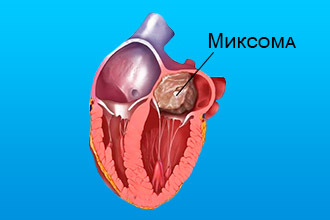 Митральный стеноз - симптомы, степени, лечение