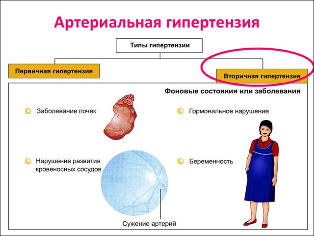 Как избавиться от гипертонии навсегда