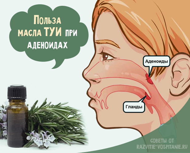 Масло туи при аденоидах для детей - инструкция по применению, отзывы о лечении аденоидов маслом туи
