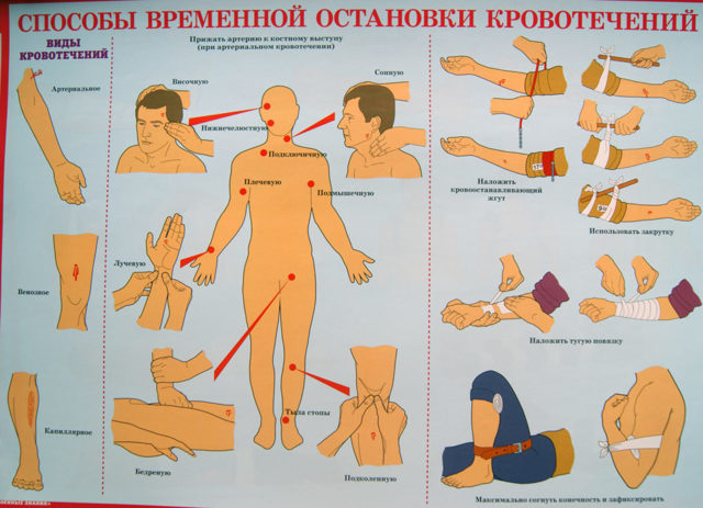Кровотечения и способы их остановки