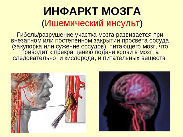 Чем отличается инфаркт миокарда от инсульта головного мозга