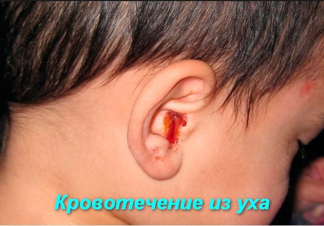 Первая помощь при кровотечениях
