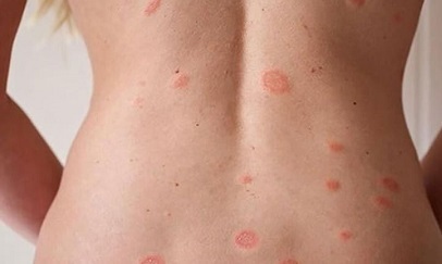 Красные пятна на теле у взрослого - появились красные пятнышки на лице