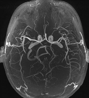 Ангиография (МРА) головного мозга. Личный опыт
